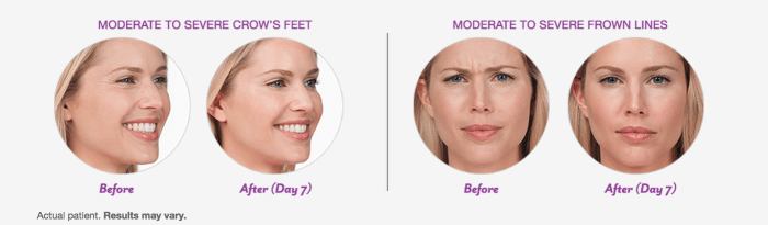 Botox Before & After Photos Chevy Chase MD