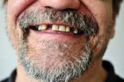 Missing teeth blog
