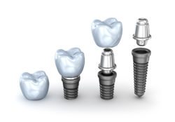 dental implants care chevy chase md