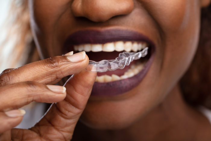 Invisalign Treatment in Chevy Chase, Maryland