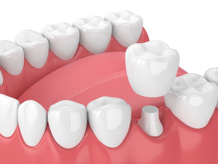 dental crown procedure benefits in Chevy Chase Maryland