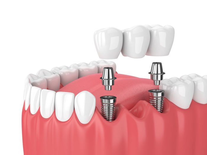 types of dental implants in Chevy Chase Maryland