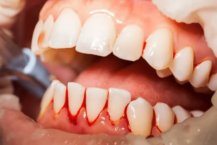 close up image of bleeding gums during a dental procedure periodontal disease restorative dentistry dentist in Chevy Chase Maryland